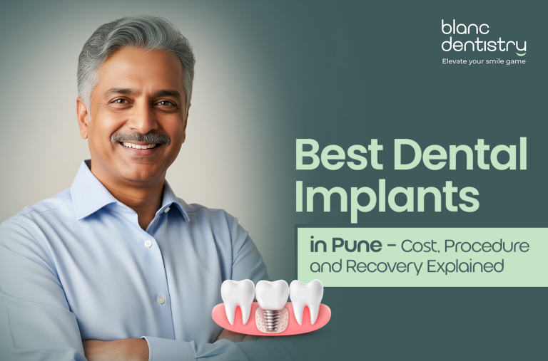 Best dental implants in Pune