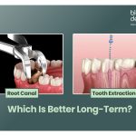 root canal treatment in Baner Pune