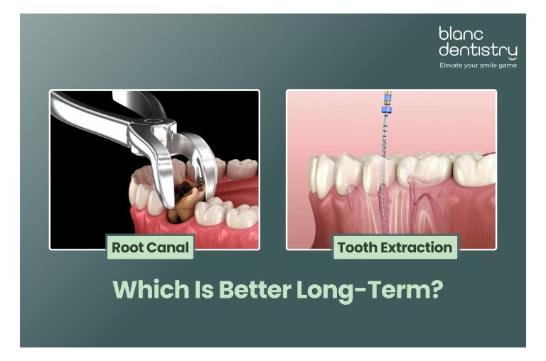 root canal treatment in Baner Pune